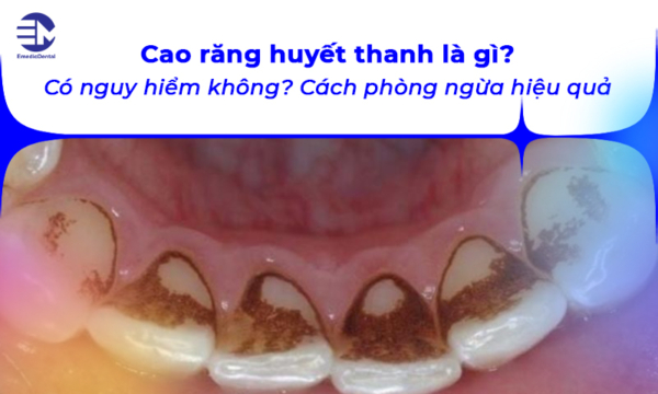 Cao răng huyết thanh là gì? Có nguy hiểm không? Cách phòng ngừa hiệu quả