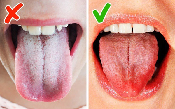 Các bệnh về lưỡi phổ biến hiện nay