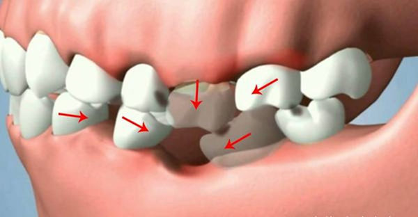 Khi bị mất răng số 6 sẽ khiến xương hàm bị lỏng lẻo làm lệch lạc các răng khác theo thời gian