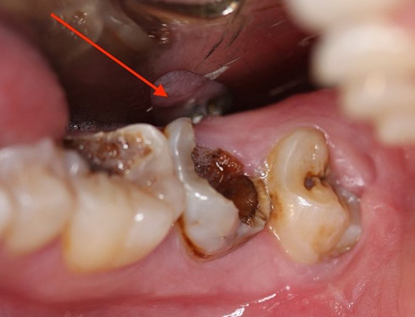 Nguyên nhân phổ biến nhất dẫn đến nhổ răng số 6 là sâu răng