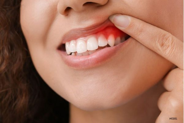 Viêm nướu, viêm lợi là một trong những nguyên nhân xuất hiện cao răng huyết thanh