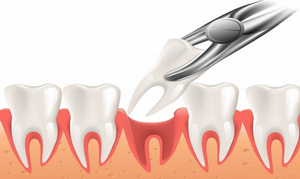  Tùy thuộc cơ địa mỗi người mà thời gian lành sau nhổ răng số 6 dao động từ 2-3 tuần