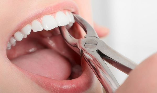 Nhổ răng số 6 vẫn tiềm ẩn một số nguy cơ nếu không được thực hiện đúng cách