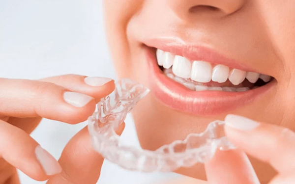 Niềng răng bằng Clear Aligner rất tiện lợi, linh hoạt vì bệnh nhân có thể dễ dàng tháo lắp để ăn uống, vệ sinh răng miệng