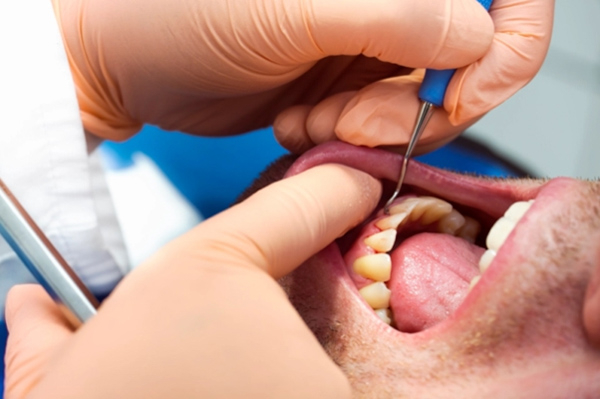 Vệ sinh răng miệng kém là một trong những nguyên nhân hàng đầu dẫn đến hình thành cao răng huyết thanh