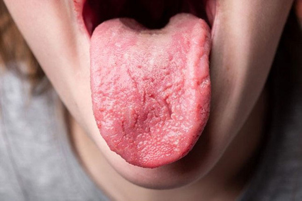 Viêm lưỡi là bệnh lý phổ biến nhất ở lưỡi