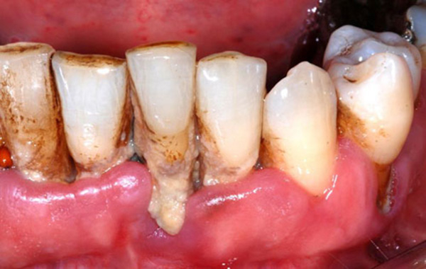 Cao răng huyết thanh là điều kiện lý tưởng để vi khuẩn phát triển làm tái phát tình trạng viêm nướu, viêm nha chu mãn tính