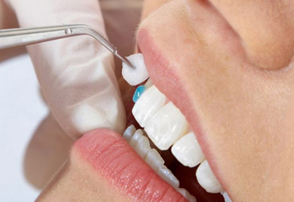 Chất lượng của keo dán sứ có ảnh hưởng rất lớn tới quá trình tháo răng sứ và cảm nhận đau đớn của người bệnh