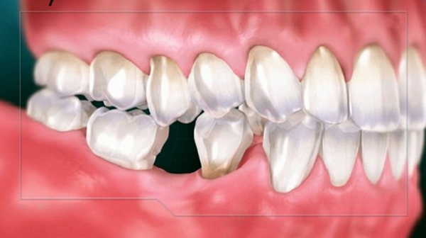 Nhổ răng số 6 sẽ tạo nên khoảng trống trên hàm làm ảnh hưởng đến khuôn mặt