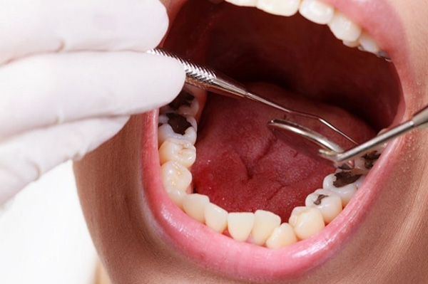 Giá nhổ răng số 6 biến động từ 800.000 – 3.500.000 đồng/răng