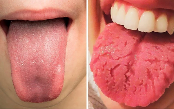 Loét lưỡi Apthae là một trong những bệnh lý thường gặp về lưỡi