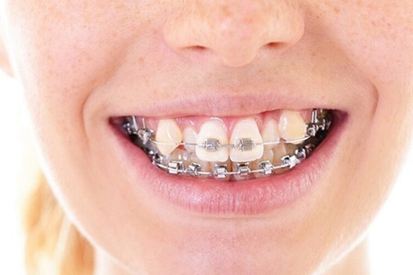 Niềng răng là phương pháp điều trị khớp cắn chéo hiệu quả