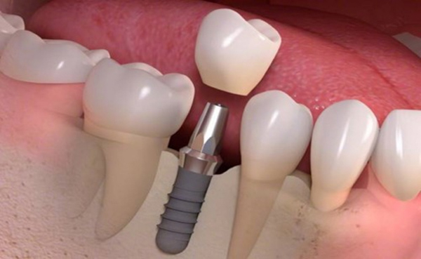 Phục hình bằng răng implant