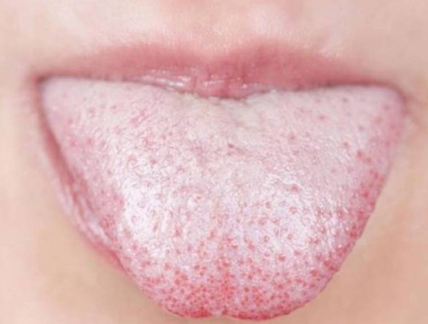 Lưỡi trắng là một tình trạng viêm nhiễm ở lưỡi, đặc trưng bởi sự xuất hiện các mảng màu trắng bám trên bề mặt