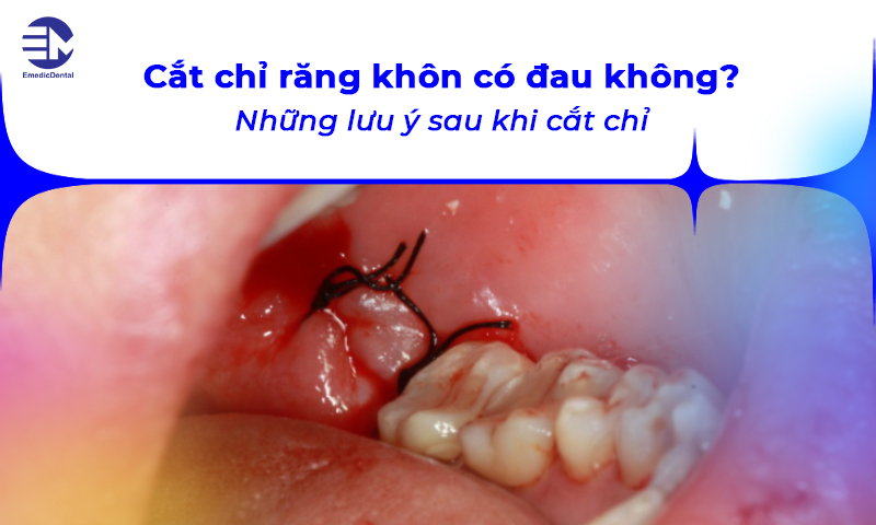 cắt chỉ răng khôn