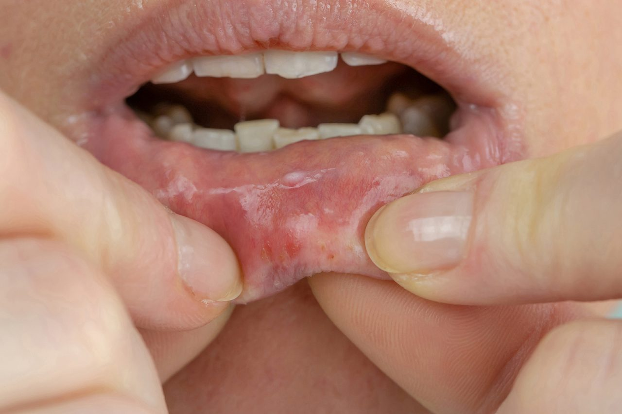Điều trị triệt để khô miệng giúp ngăn ngừa các bệnh nguy hiểm về răng miệng