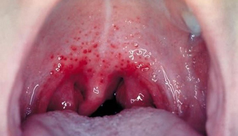 Chảy máu thường xuyên là biến chứng nguy hiểm nhất ở bệnh nhân u máu trong miệng