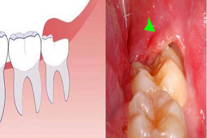 Mức độ tổn thương lên các cơ quan xung quanh như xương, mô mềm, thần kinh trong khi nhổ răng khôn phụ thuộc nhiều yếu tố