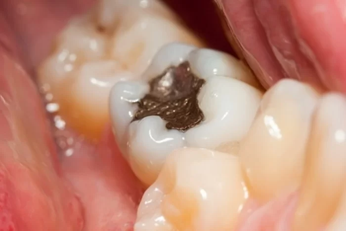 Trám răng không chuẩn, không vừa vặn với kích thước răng thật sẽ dẫn đến đau nhức