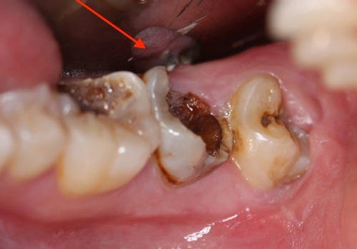 Răng bị hư tủy là một trong những nguyên nhân khiến răng trám dễ bị đau đớn và khó chịu