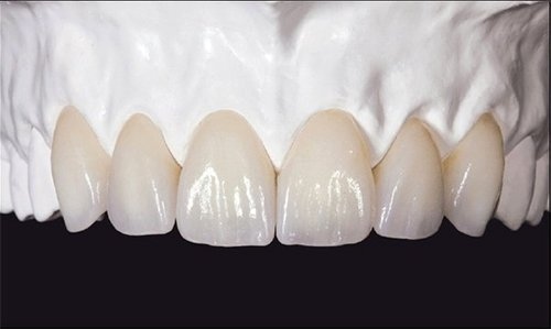 Răng sứ zirconia chính là sự lựa chọn hoàn hảo nhất để bọc cả hàm hiện nay