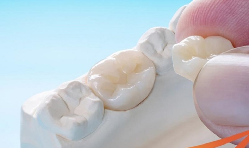 Quy trình bọc răng sứ toàn hàm