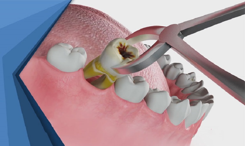 Việc nhổ răng được khuyến cáo khi răng đã bị hư hỏng không thể phục hồi được