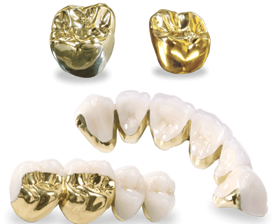 Bọc răng vàng sở hữu nhiều ưu điểm vượt trội, khiến phương pháp này ngày càng được ưa chuộng