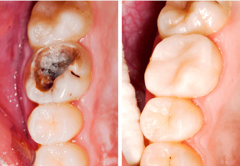 Răng trám bị vỡ, rớt không trám lại sẽ dẫn đến nguy cơ mắc sâu răng nặng
