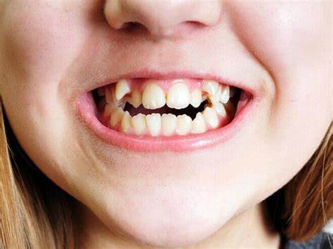 Răng mọc chồi, răng khểnh là một dạng của răng mọc thừa