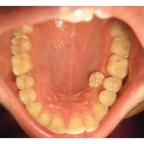 Răng thừa ở hàm dưới