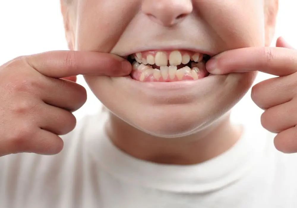 Các thói quen, hành vi sai cách trong sinh hoạt hàng ngày cũng có thể khiến răng mọc thưa và lệch lạc
