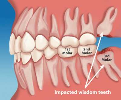 Tình trạng răng mọc thừa thường dẫn tới số chiếc răng vượt quá 32 răng