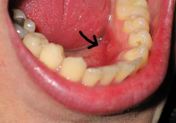 Nhiễm trùng hàm răng là một trong những biến chứng nguy hiểm có thể xảy ra sau khi nhổ răng