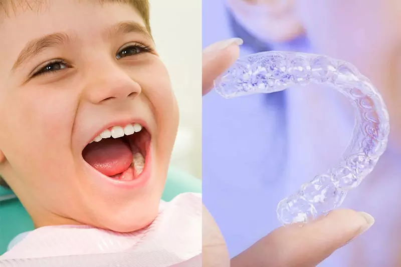 Niềng răng bằng mắc cài cố định là phương pháp được sử dụng phổ biến cho trẻ