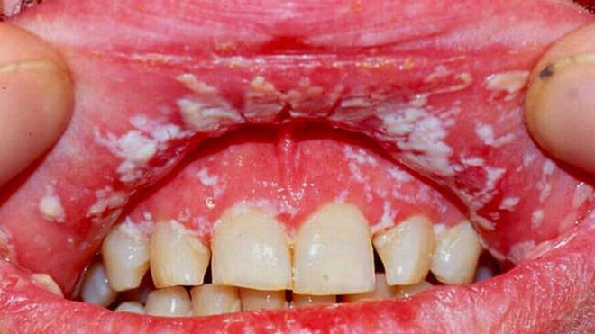 Mảng trắng trong miệng, còn được gọi là bệnh nấm miệng