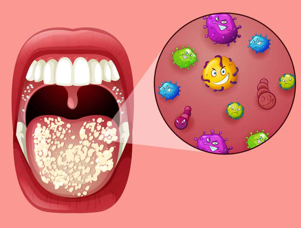Sự tăng sinh quá mức của nấm Candida trong miệng được cho là nguyên nhân chính gây nên tình trạng mảng trắng