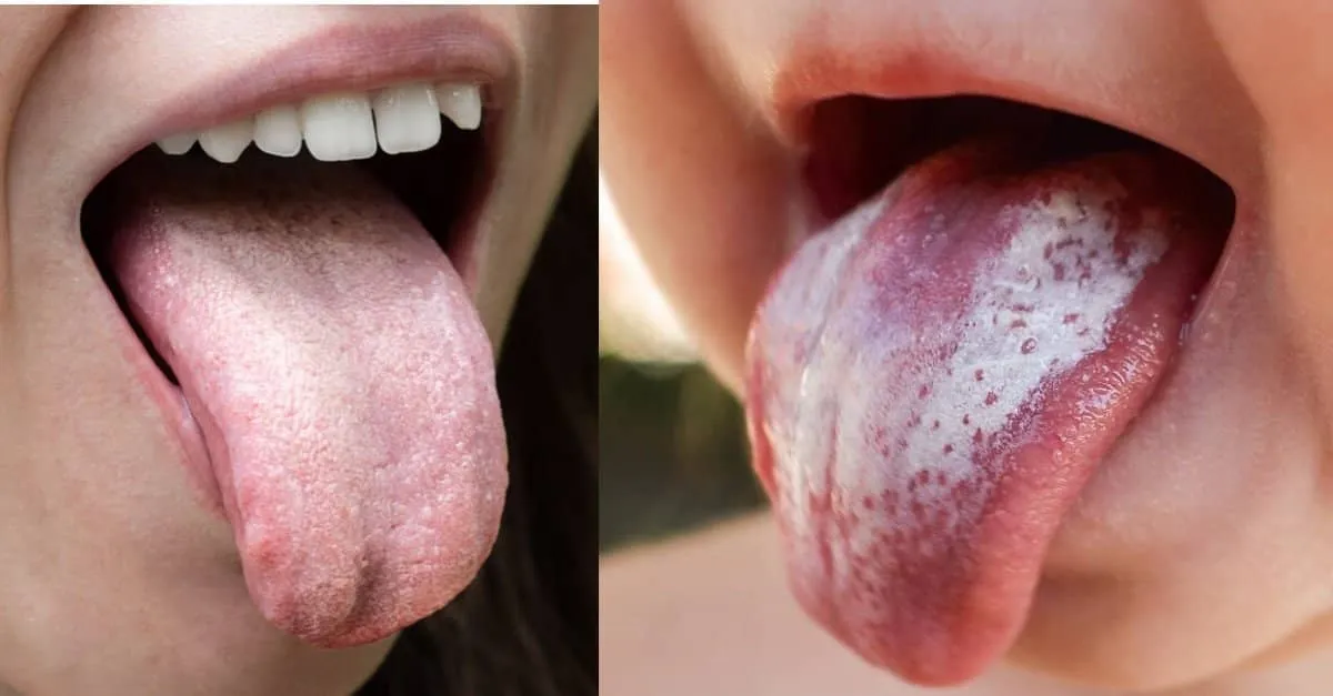 Triệu chứng điển hình của bệnh nấm miệng
