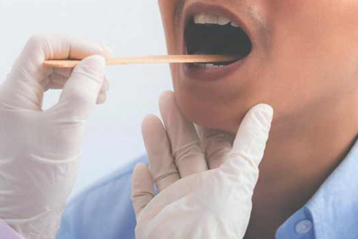 Cách chẩn đoán chính xác bệnh nấm miệng
