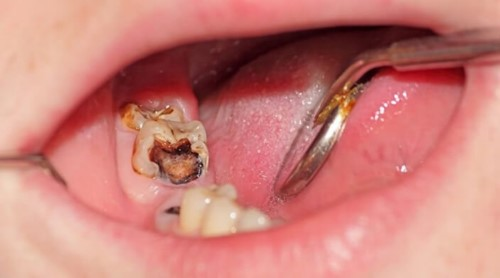 Viêm tủy răng kiêng ăn gì?
