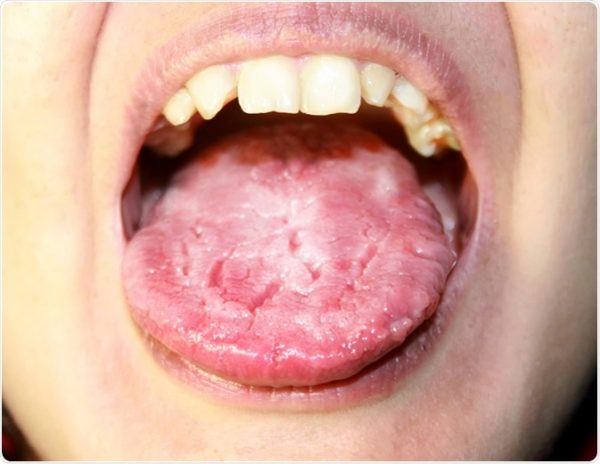 Nếu tình trạng nhiễm nấm trong miệng không được điều trị kịp thời, bệnh có thể gây ra các biến chứng nguy hiểm