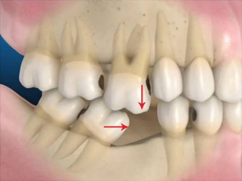 Khi bị mất răng số 6, không gian trống trên hàm sẽ khiến các răng còn lại mất dần điểm tựa