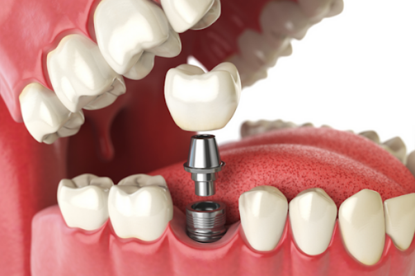 Trồng răng Implant thay thế răng số 6