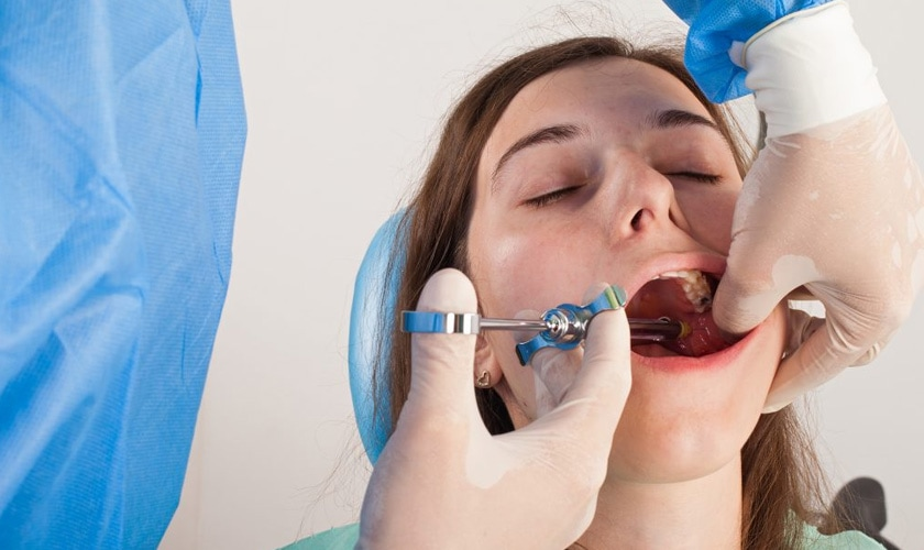 Trồng Implant răng số 6 có đau không?