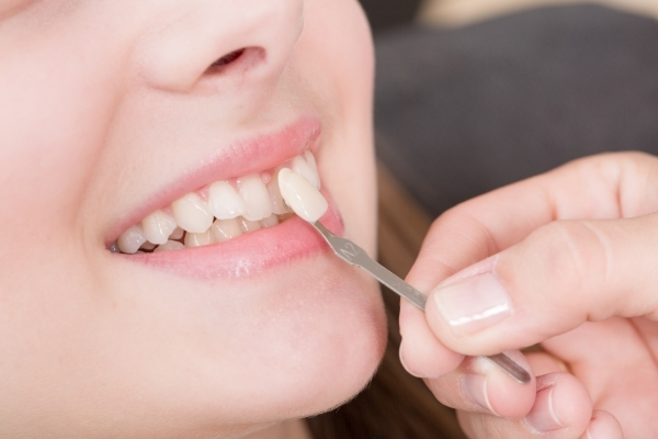 Quy trình bọc răng sứ mất bao lâu còn tùy thuộc vào nhiều yếu tố