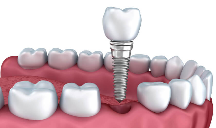 Trồng implant thay thế sớm giúp giữ gìn cấu trúc xương hàm