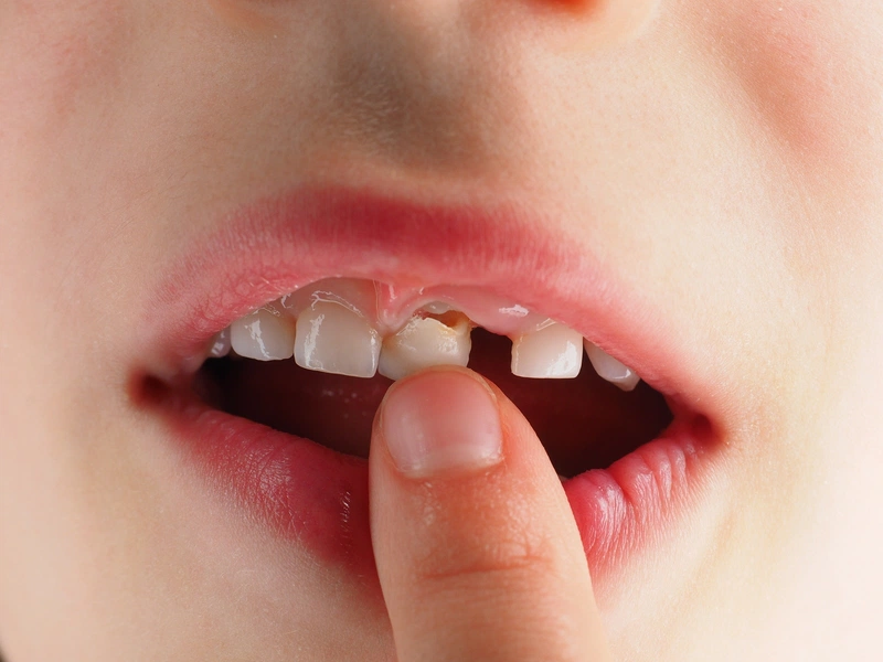 Có nên nhổ răng tại nhà hay không?