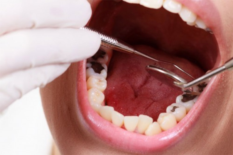 Có một số trường hợp tuyệt đối không được phép tự nhổ răng tại nhà
