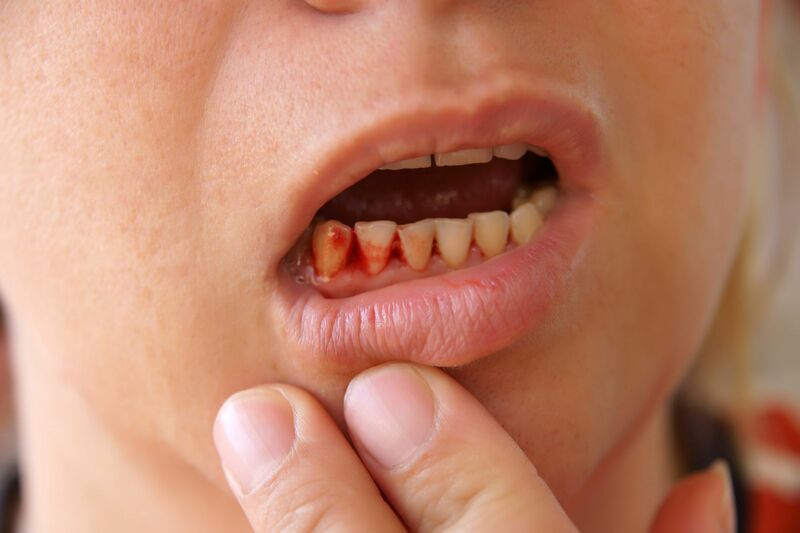 Chảy máu là biến chứng phổ biến và nguy hiểm nhất khi nhổ răng tại nhà