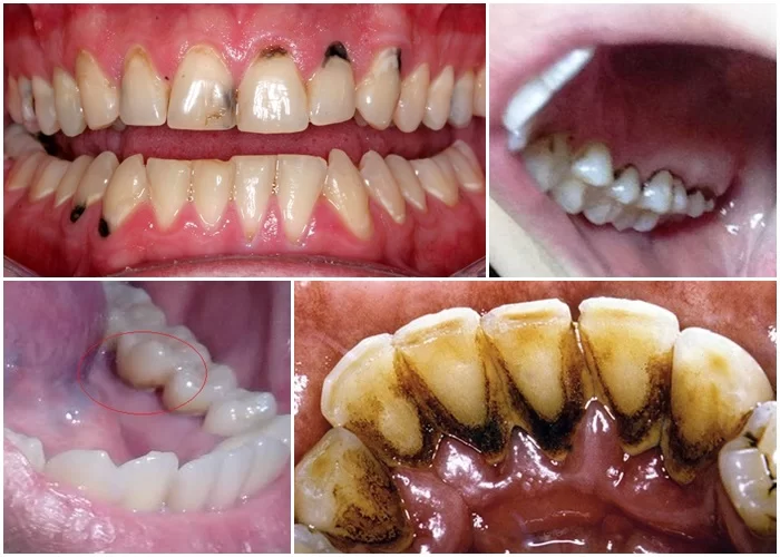 Răng bị đen ở mặt trong không chỉ gây mất thẩm mỹ mà còn tiềm ẩn nhiều nguy cơ đe dọa đến sức khỏe răng miệng